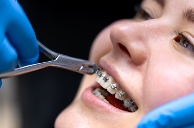Braces Treatment