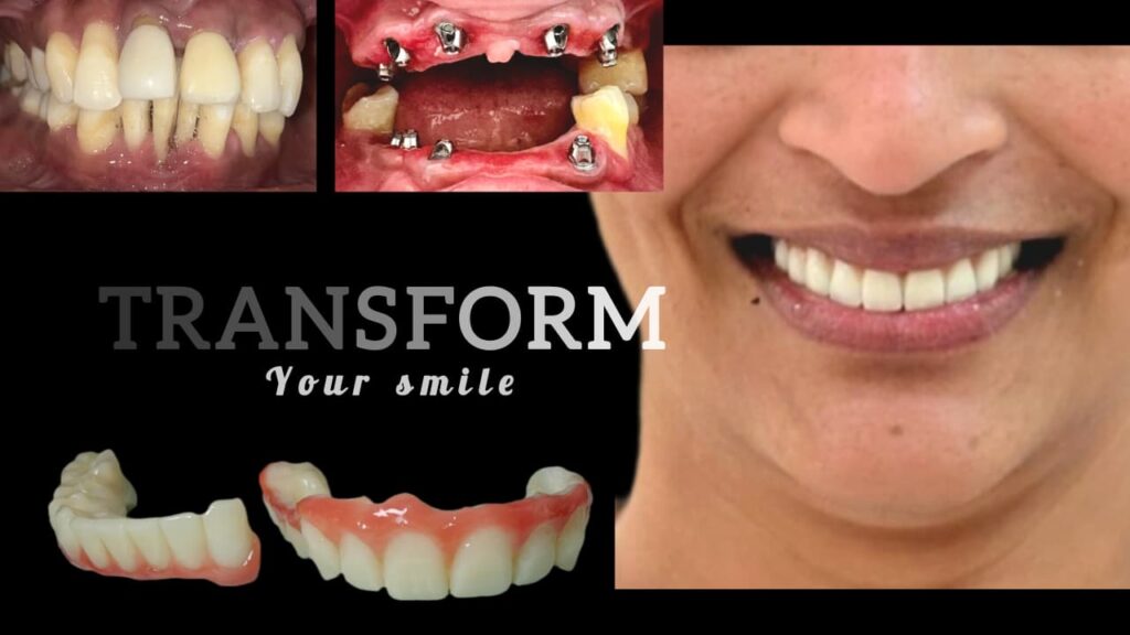 Full mouth rehabilitation with dental implants and crowns before and after