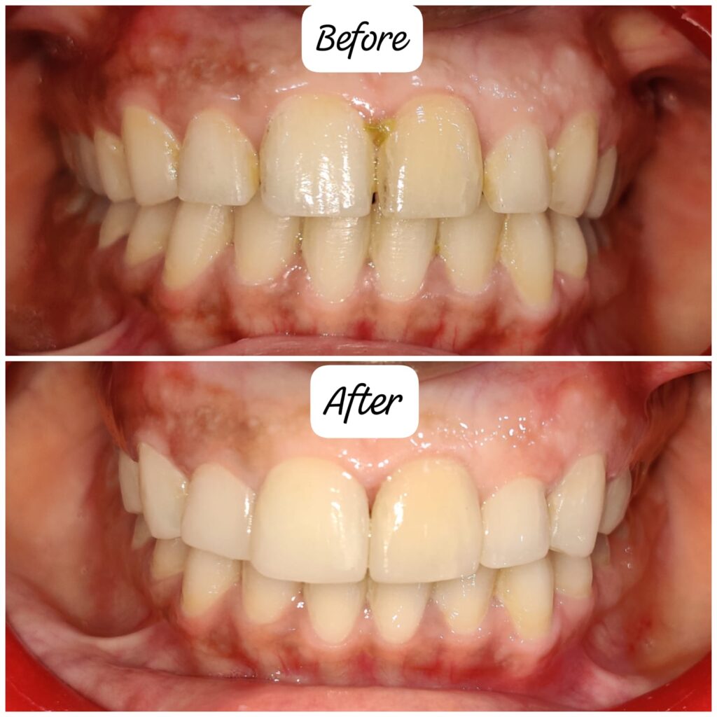 Before and after composite veneers smile transformation