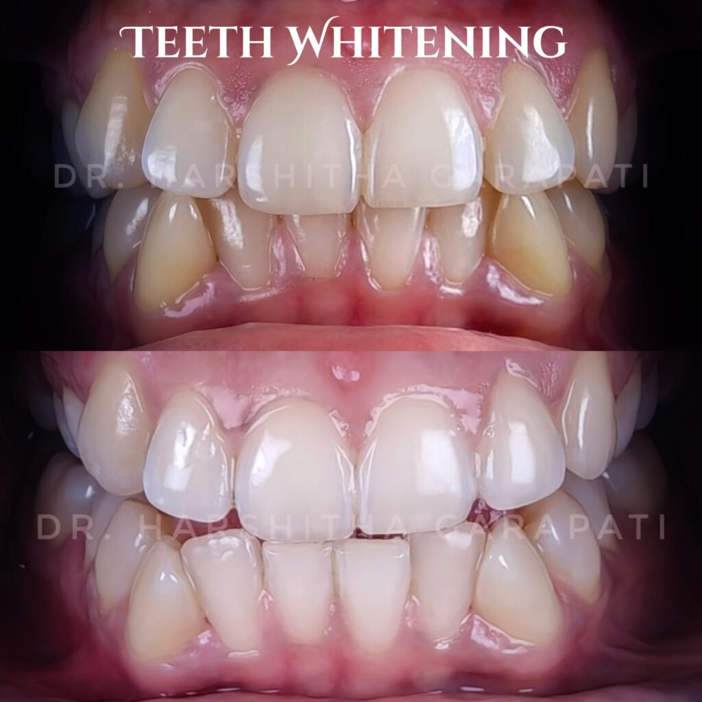 Teeth whitening before and after smile transformation
