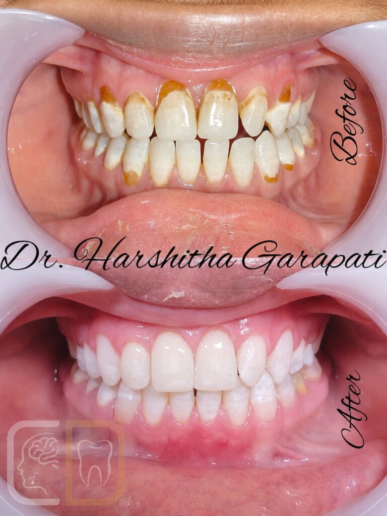 Before and after composite veneers smile makeover