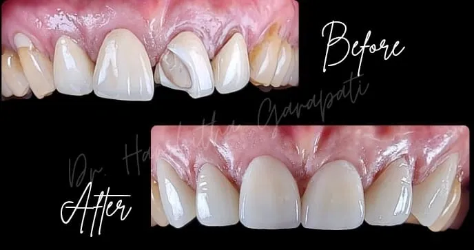 Cosmetic dentistry with ceramic crowns smile makeover before and after