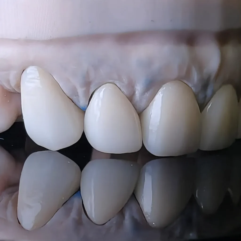Seamless ceramic crowns for a natural smile makeover