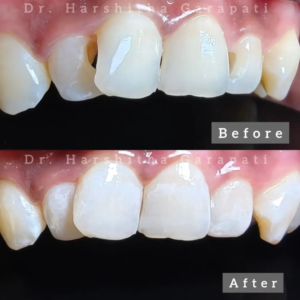 Before and after minimally invasive composite fillings