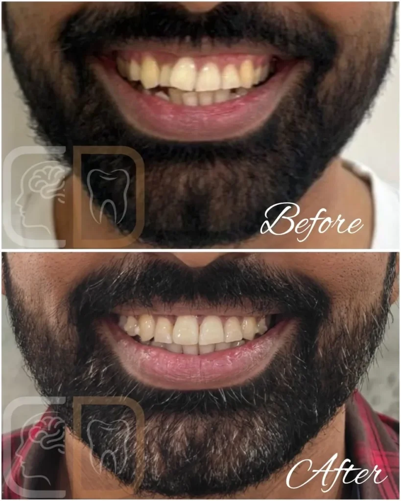 Invisalign before and after smile transformation
