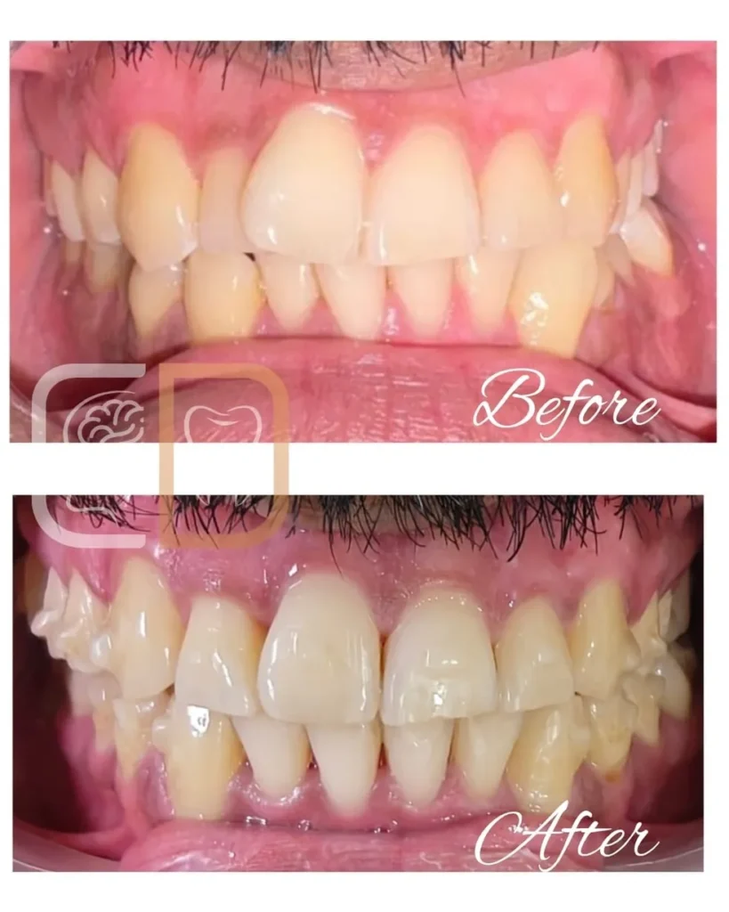 Before and after Invisalign aligners smile transformation