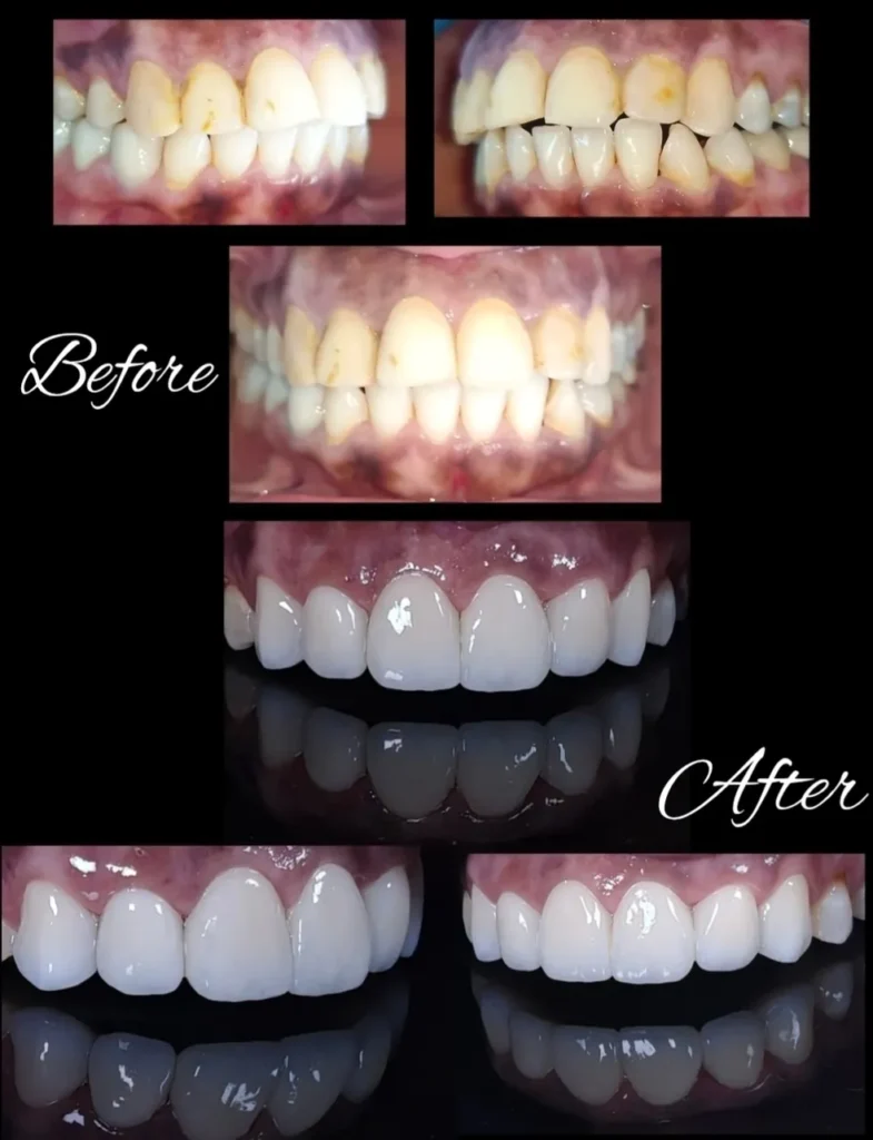 Aesthetic smile transformation before and after