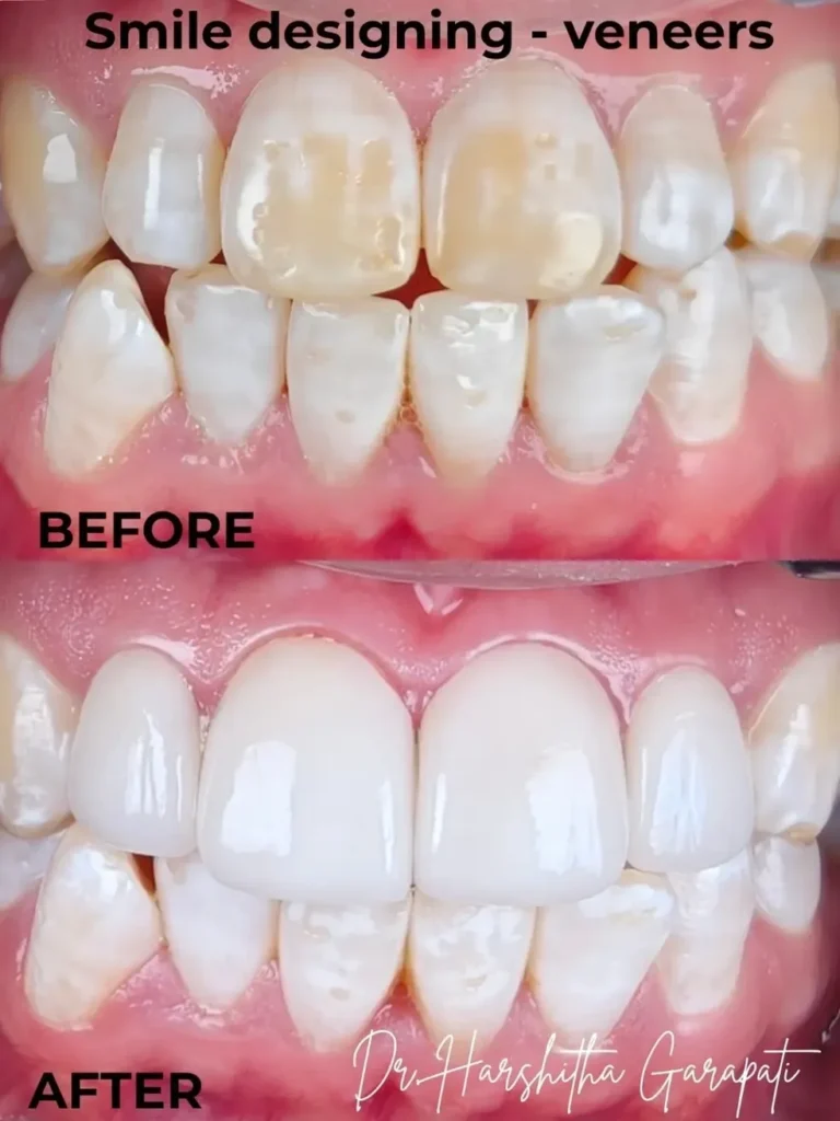 Ceramic veneers smile makeover before and after