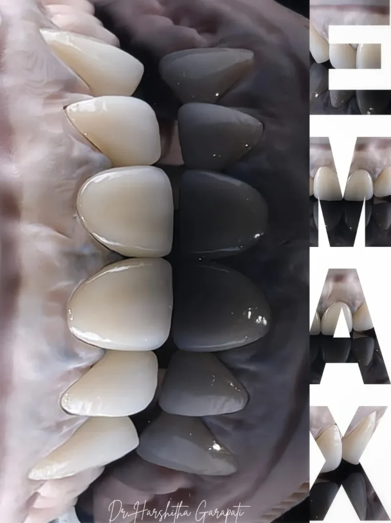 Ceramic crowns with a natural-looking smile makeover