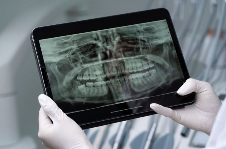 Full-Mouth X-Ray