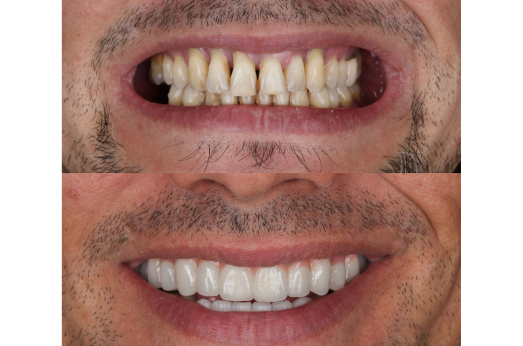 Full Mouth Rehabilitation