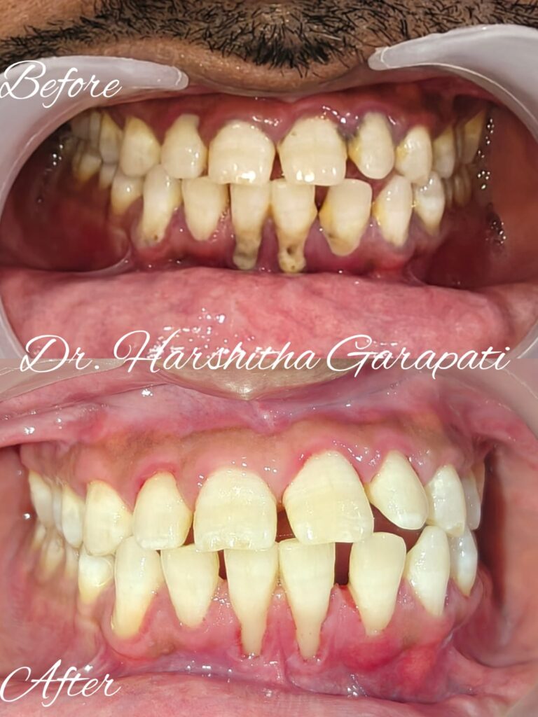 Before and after smile transformation
