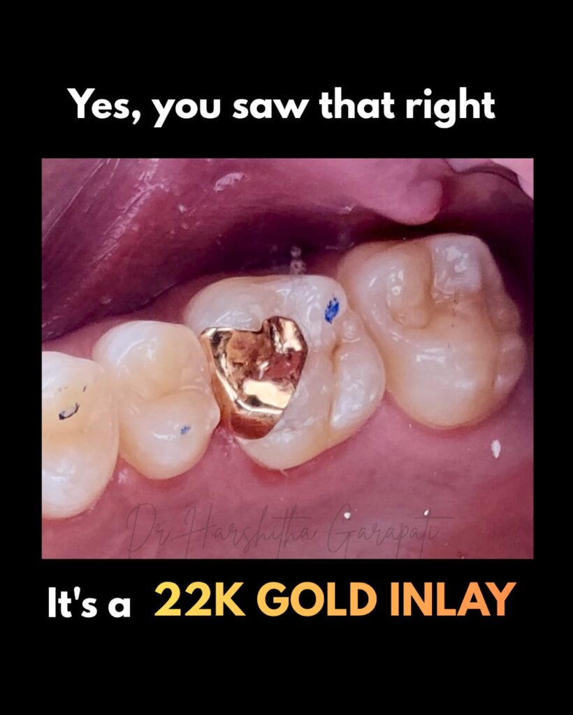 22k Gold Inlay