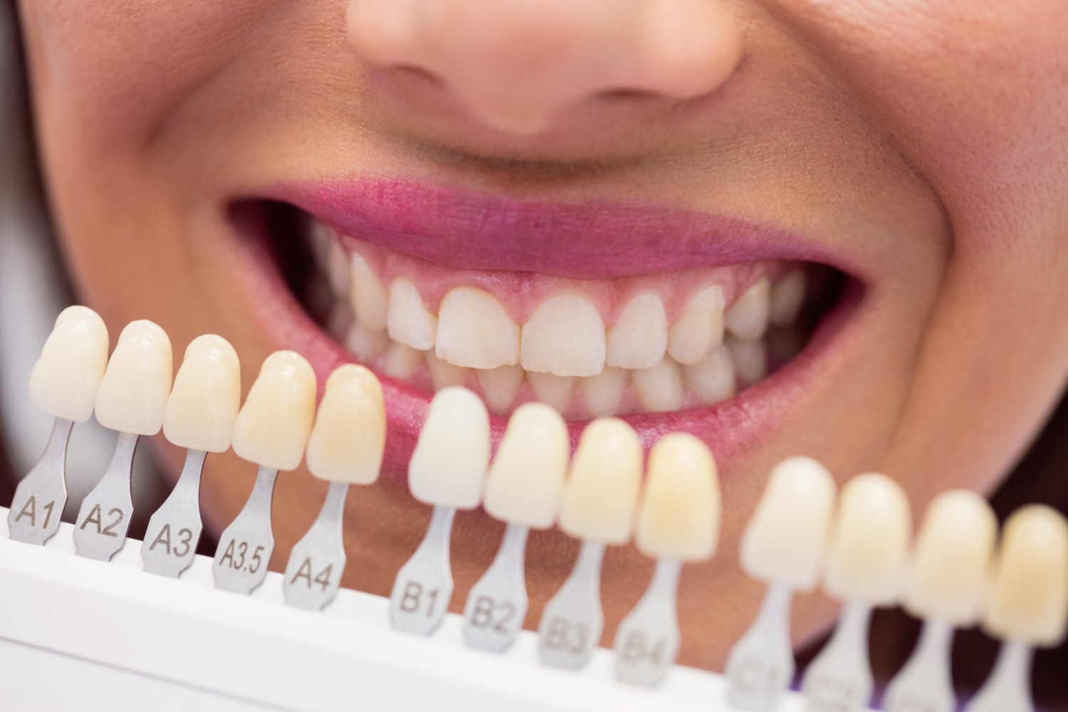 Ceramic Veneers
