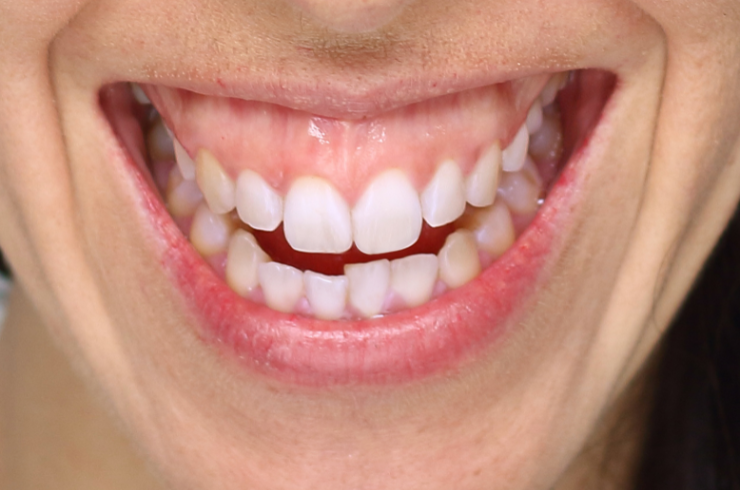 Gummy Smile Correction
