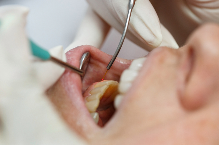 LANAP (Laser-Assisted New Attachment Procedure)