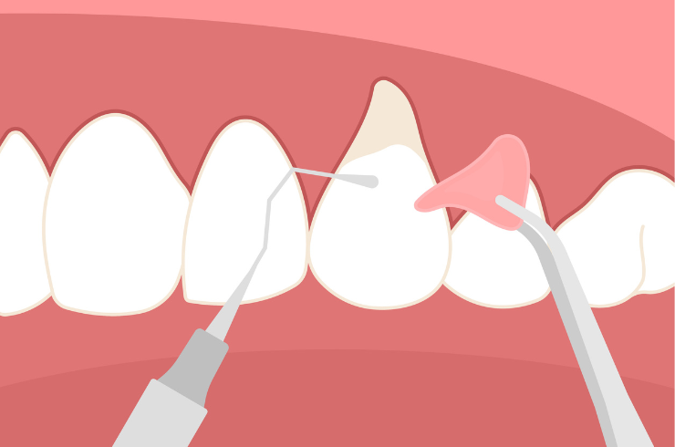 Laser Flap Surgery