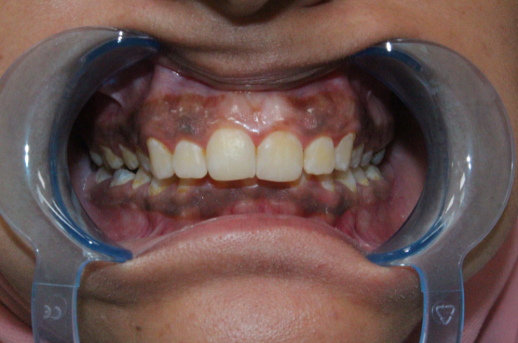 Gingival Depigmentation