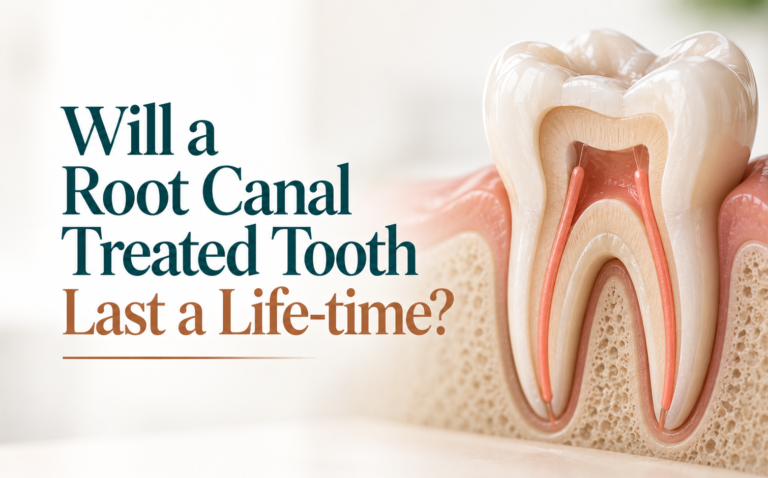 Will a root canal treated tooth last a lifetime? A cross-sectional illustration of a root canal treated molar.