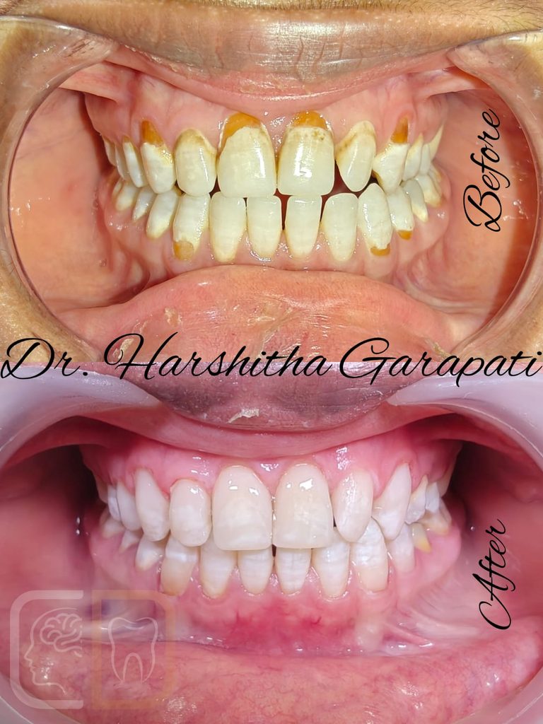 composite veneers before and after treatment image