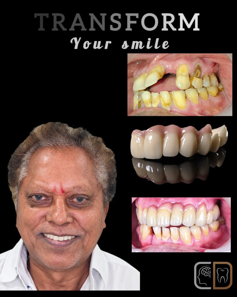 SMILE TRANSFORMATION OF A 60 YEAR ADULT, RESTORING FUNCTION, ESTHETICS AND CONFIDENCE AT COGNIDENT
