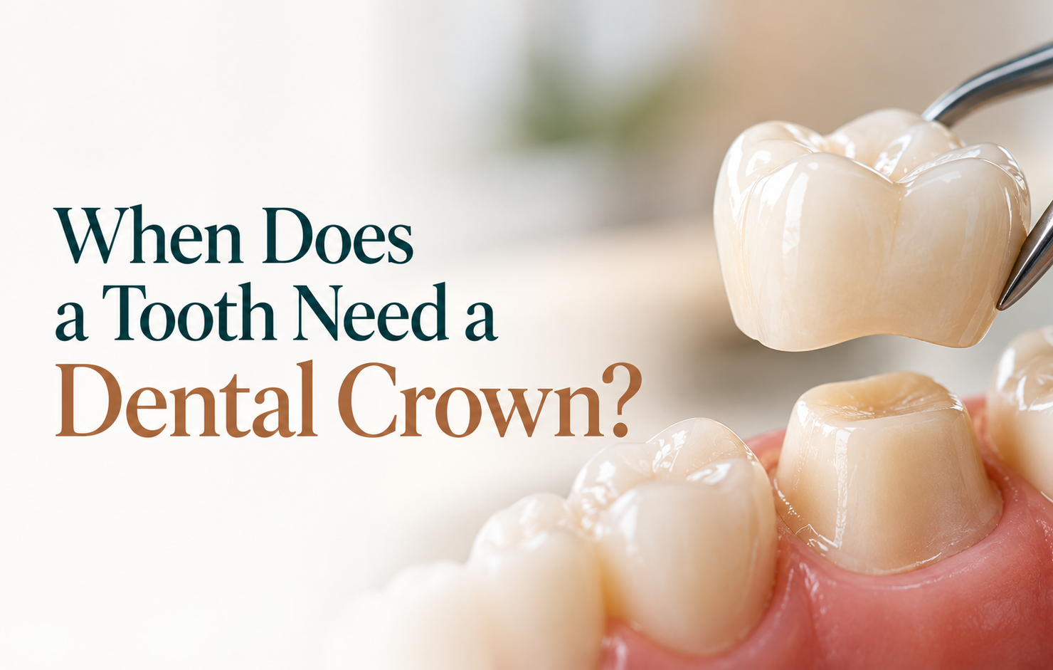 When Does a Tooth Need a Dental Crown?
